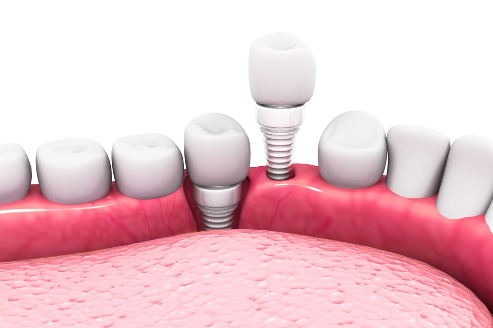 implant dentar ceramic, implant ceramic